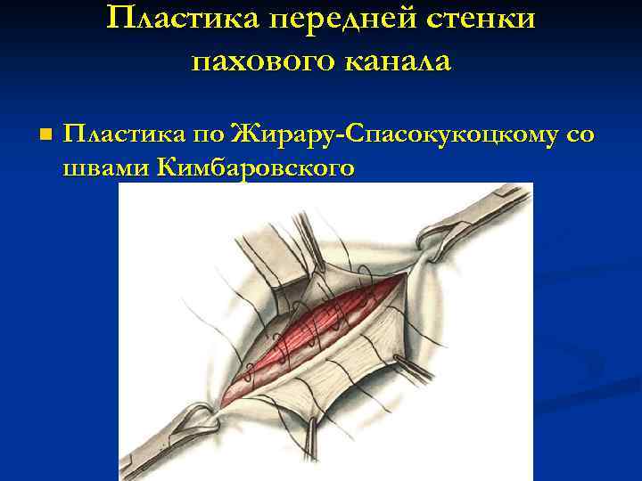 Схемы пластики пахового канала по мартынову