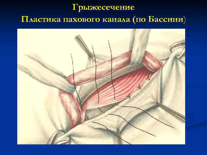 Грыжесечение Пластика пахового канала (по Бассини) 
