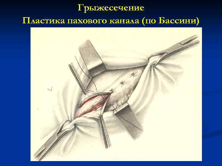 Грыжесечение Пластика пахового канала (по Бассини) 