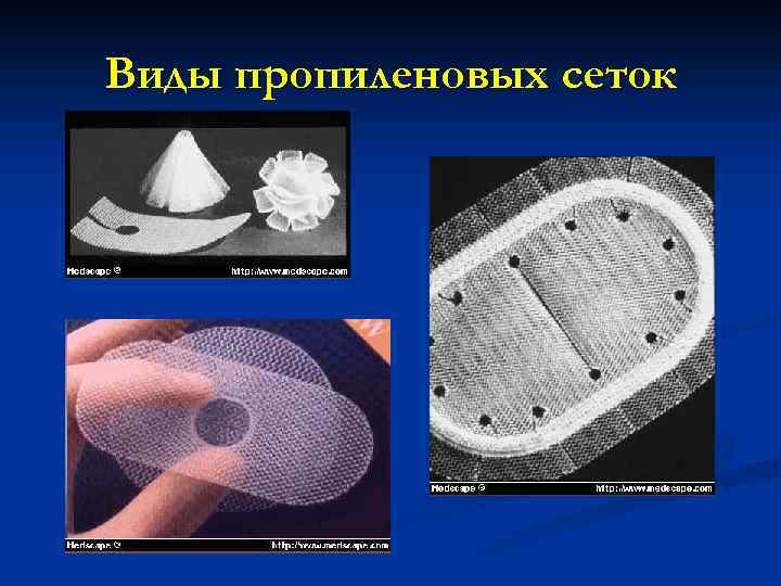 Виды пропиленовых сеток 