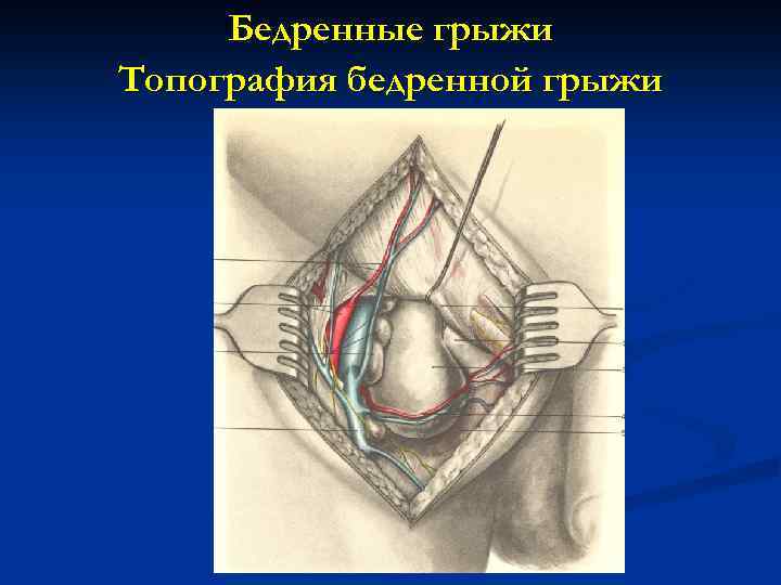 Бедренные грыжи Топография бедренной грыжи 
