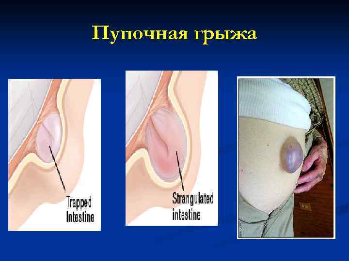 Пупочная грыжа 