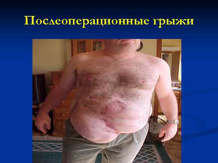 Послеоперационные грыжи 