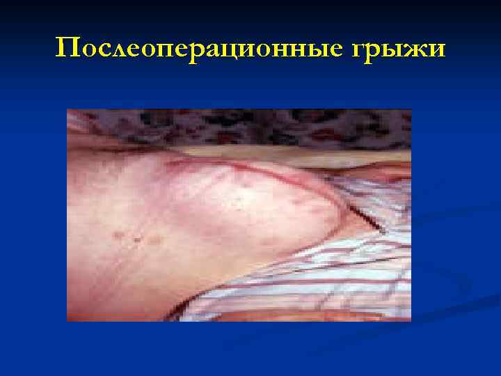 Послеоперационные грыжи 
