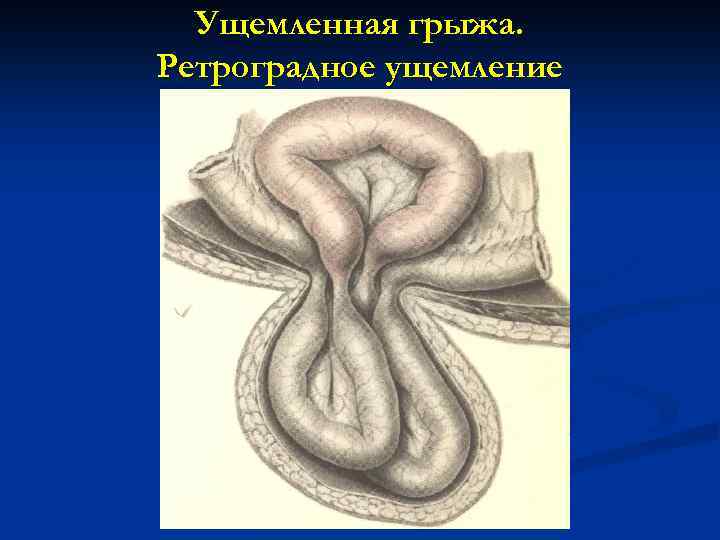 Ущемленная грыжа. Ретроградное ущемление 