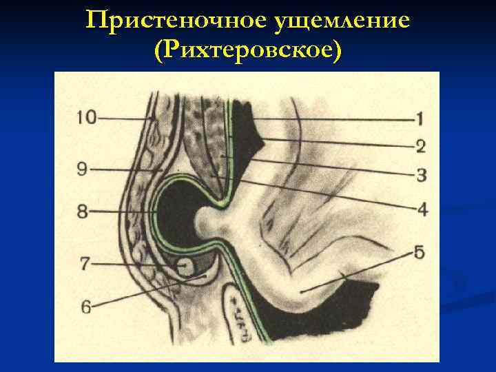 Грыжи факультетская хирургия презентация