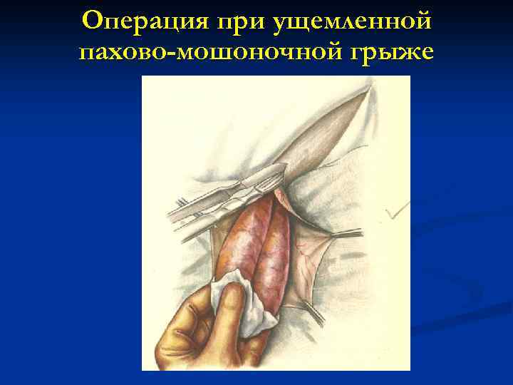 Операция при ущемленной пахово-мошоночной грыже 