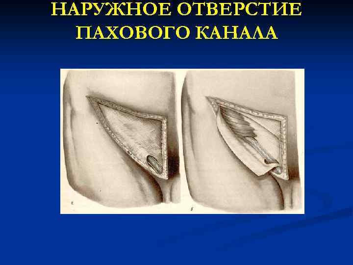 НАРУЖНОЕ ОТВЕРСТИЕ ПАХОВОГО КАНАЛА 