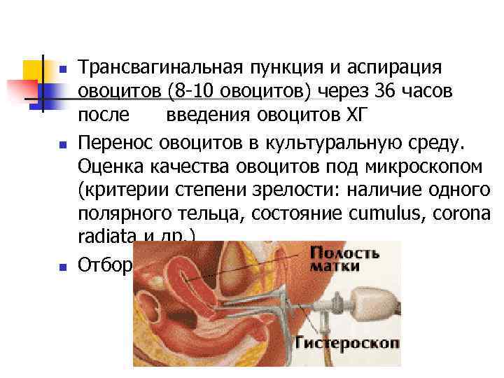 n n n Трансвагинальная пункция и аспирация овоцитов (8 -10 овоцитов) через 36 часов