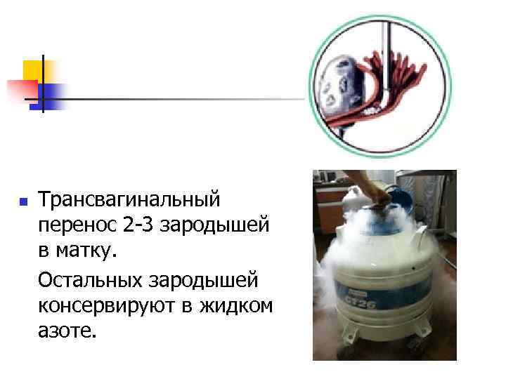 n Трансвагинальный перенос 2 -3 зародышей в матку. Остальных зародышей консервируют в жидком азоте.