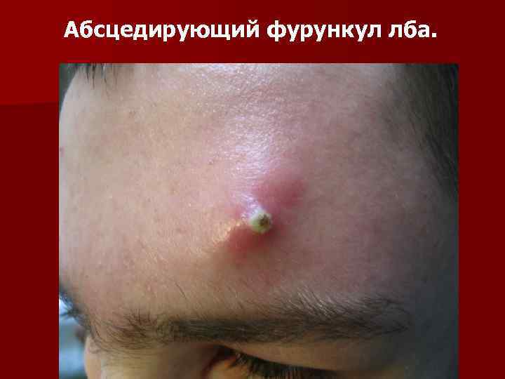 Абсцедирующий фурункул лба. 