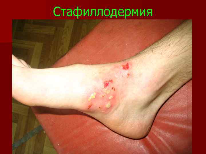 Стафиллодермия 