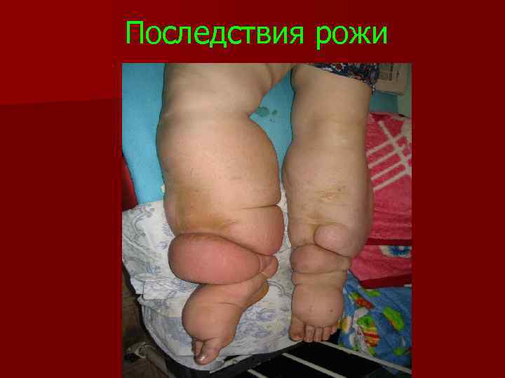 Последствия рожи 