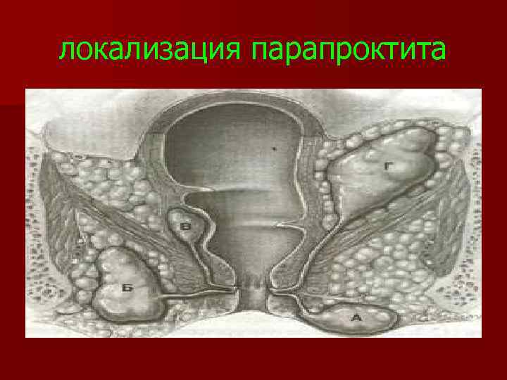 локализация парапроктита 