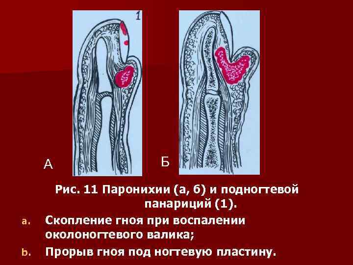 А a. b. Б Рис. 11 Паронихии (а, б) и подногтевой панариций (1). Скопление