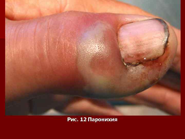 Рис. 12 Паронихия 