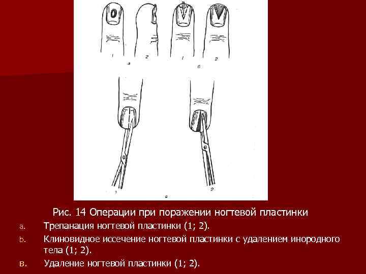 Рис. 14 Операции при поражении ногтевой пластинки a. b. в. Трепанация ногтевой пластинки (1;