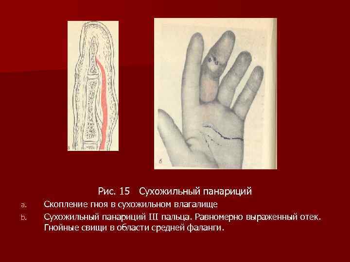 Рис. 15 Сухожильный панариций a. b. Скопление гноя в сухожильном влагалище Сухожильный панариций III