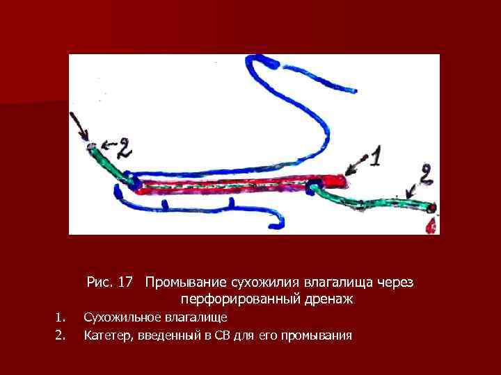 Рис. 17 Промывание сухожилия влагалища через перфорированный дренаж 1. 2. Сухожильное влагалище Катетер, введенный