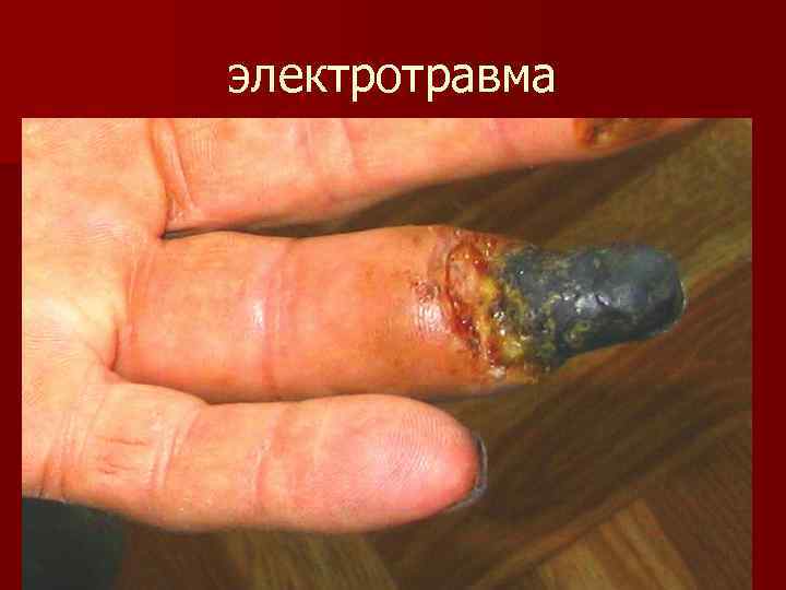 электротравма 