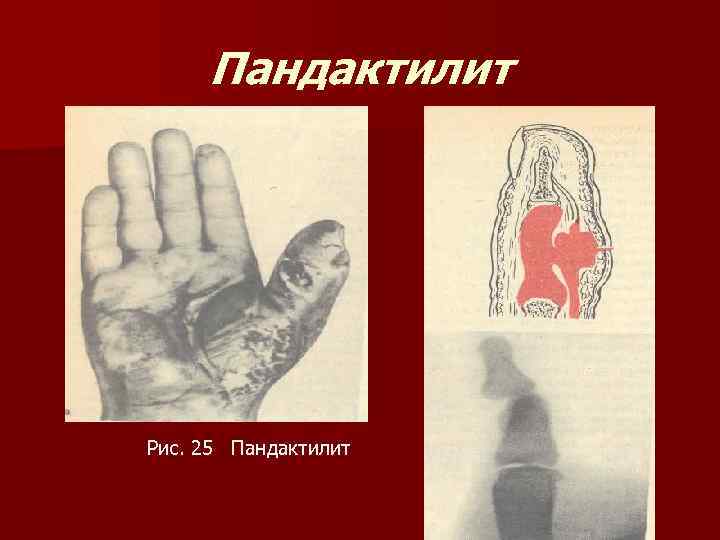 Пандактилит Рис. 25 Пандактилит 