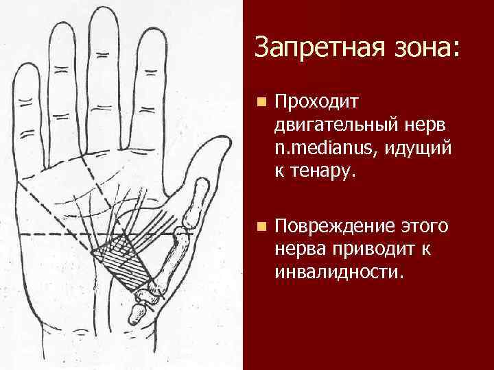 Запретная зона: n Проходит двигательный нерв n. medianus, идущий к тенару. n Повреждение этого