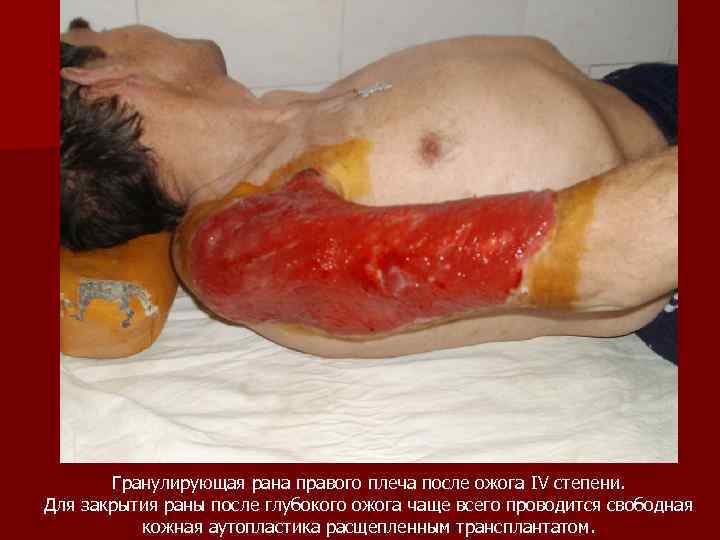 Гранулирующая рана правого плеча после ожога IV степени. Для закрытия раны после глубокого ожога