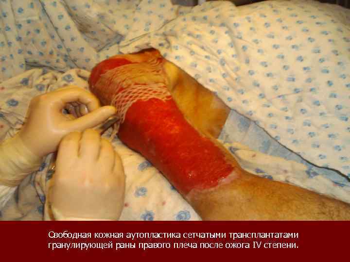 Свободная кожная аутопластика сетчатыми трансплантатами гранулирующей раны правого плеча после ожога IV степени. 