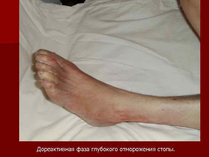 Дореактивная фаза глубокого отморожения стопы. 