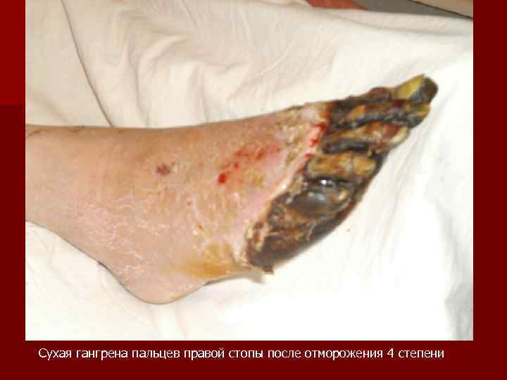 Сухая гангрена пальцев правой стопы после отморожения 4 степени 