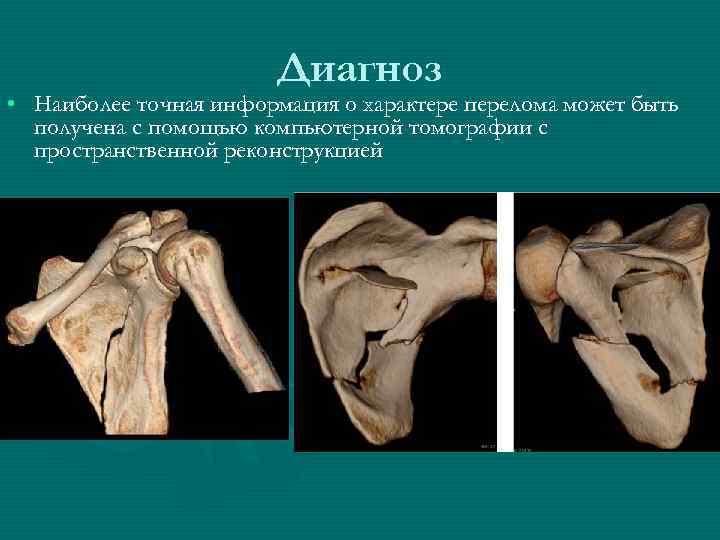 Диагноз • Наиболее точная информация о характере перелома может быть получена с помощью компьютерной