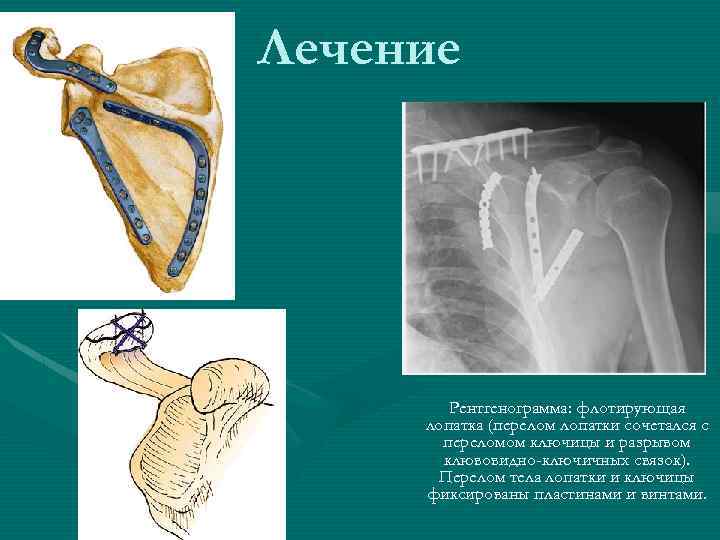 Перелом лопатки