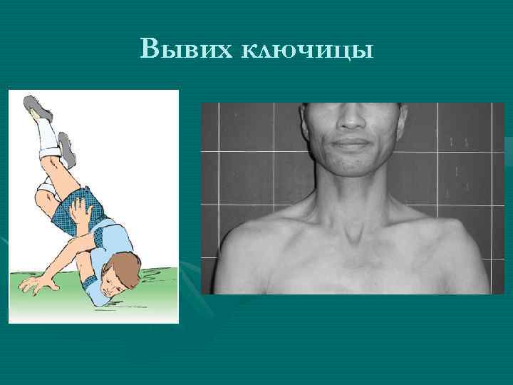 Вывих ключицы 