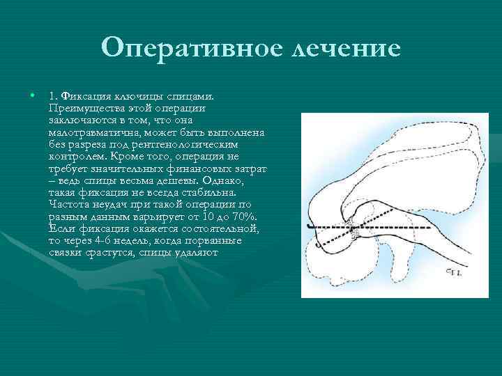 Оперативное лечение • 1. Фиксация ключицы спицами. Преимущества этой операции заключаются в том, что