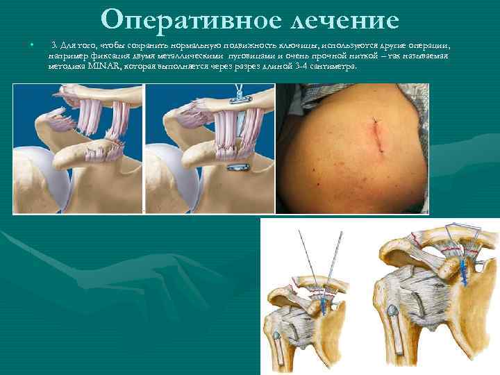 Оперативное лечение • 3. Для того, чтобы сохранить нормальную подвижность ключицы, используются другие операции,