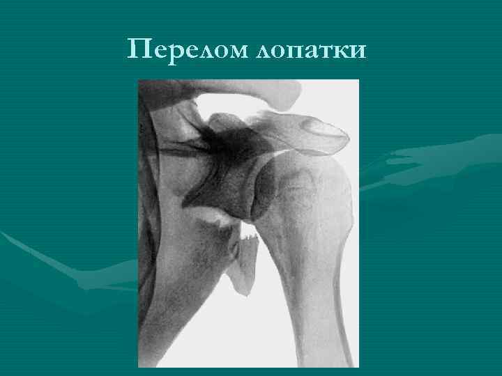 Перелом лопатки 