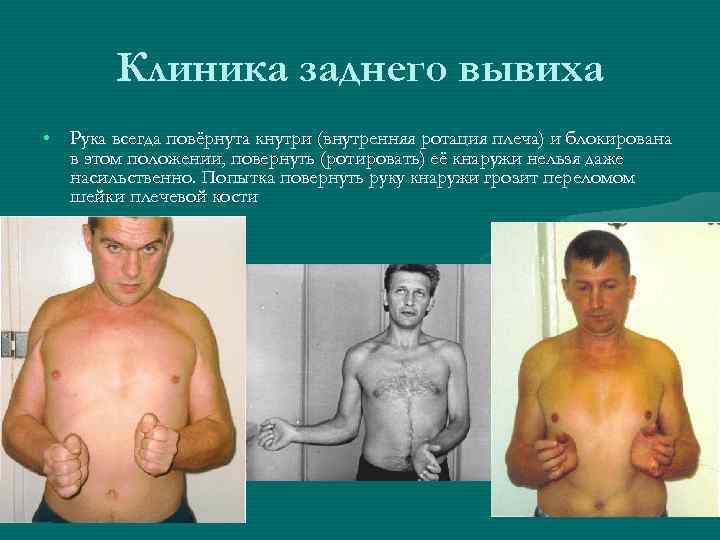 Клиника заднего вывиха • Рука всегда повёрнута кнутри (внутренняя ротация плеча) и блокирована в