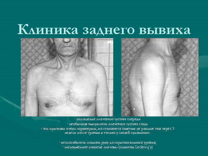 Клиника заднего вывиха · уплощение плечевого сустава спереди · необычная выпуклость плечевого сустава сзади