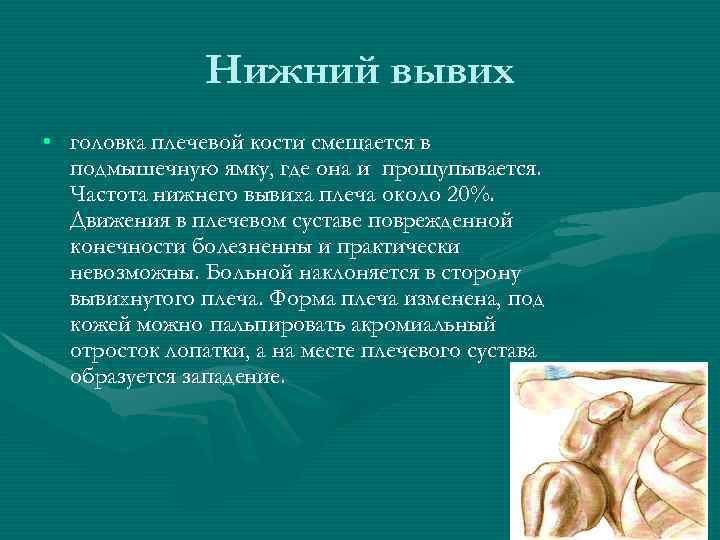 Нижний вывих • головка плечевой кости смещается в подмышечную ямку, где она и прощупывается.