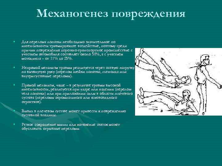 Механогенез повреждения • Для перелома лопатки необходимо значительное по интенсивности травмирующее воздействие, поэтому среди