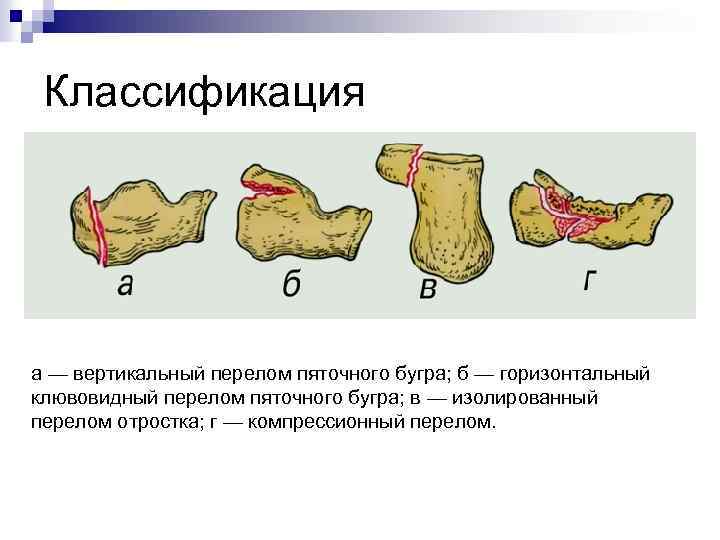 Классификация а — вертикальный перелом пяточного бугра; б — горизонтальный клювовидный перелом пяточного бугра;