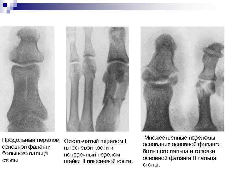 Продольный перелом основной фаланги большого пальца стопы Оскольчатый перелом I плюсневой кости и поперечный