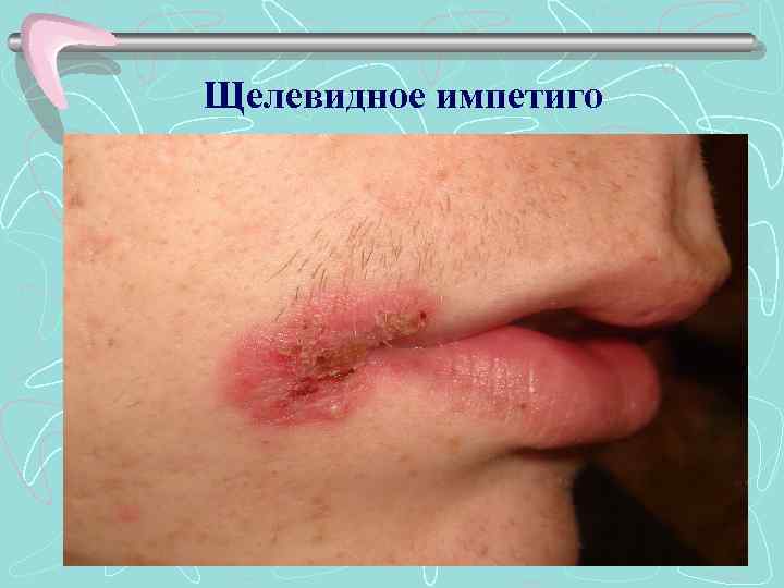 Щелевидное импетиго 01. 02. 2018 16 