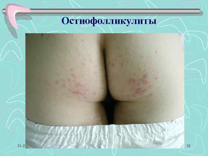 Остиофолликулиты 01. 02. 2018 30 