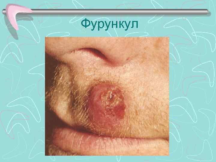 Фурункул 
