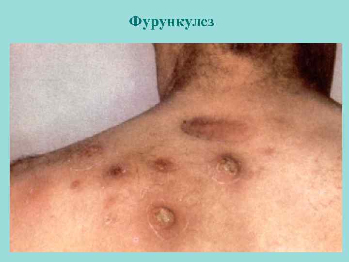 Фурункулез 