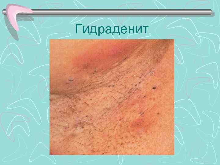 Гидраденит 