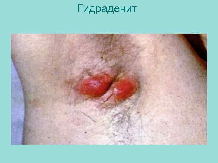 Гидраденит 