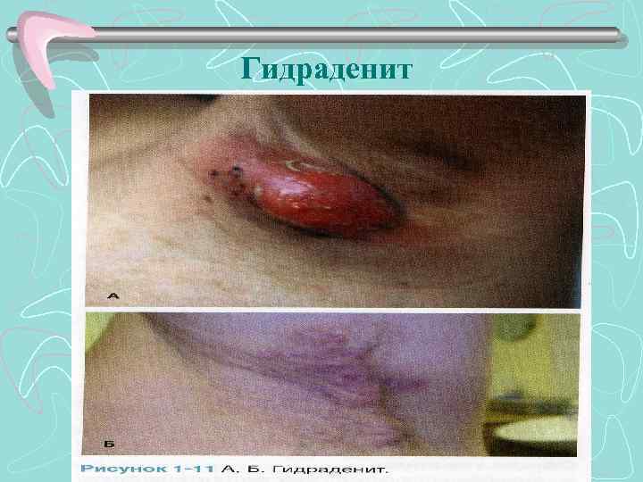 Гидраденит 