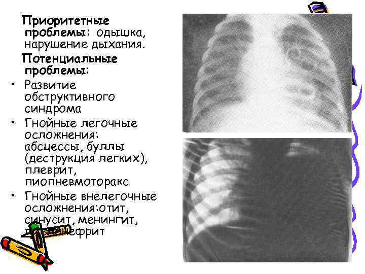 Приоритетные проблемы: одышка, нарушение дыхания. Потенциальные проблемы: • Развитие обструктивного синдрома • Гнойные легочные